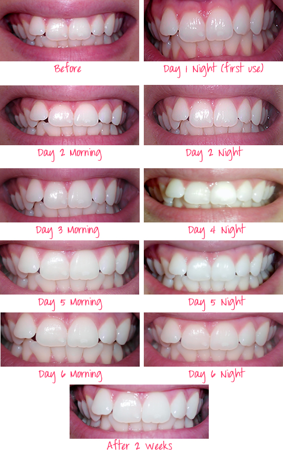 5 minute teeth whitening